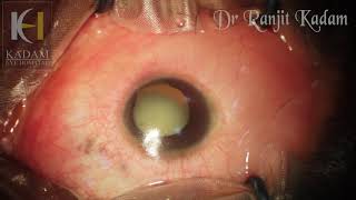 Phacosurgery in a case of Microphthalmos and micro cornea with coloboma with Mature cataract