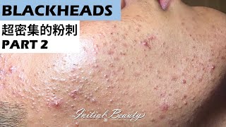 超密集的粉刺(blackheads) part 2 - Taiwan Tainan台南清粉刺最乾淨