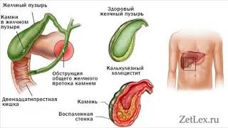 O't qopi olib tashlangandan keyingi holatarlar