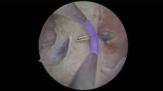 Vaginal synechia hysteroscopic repair