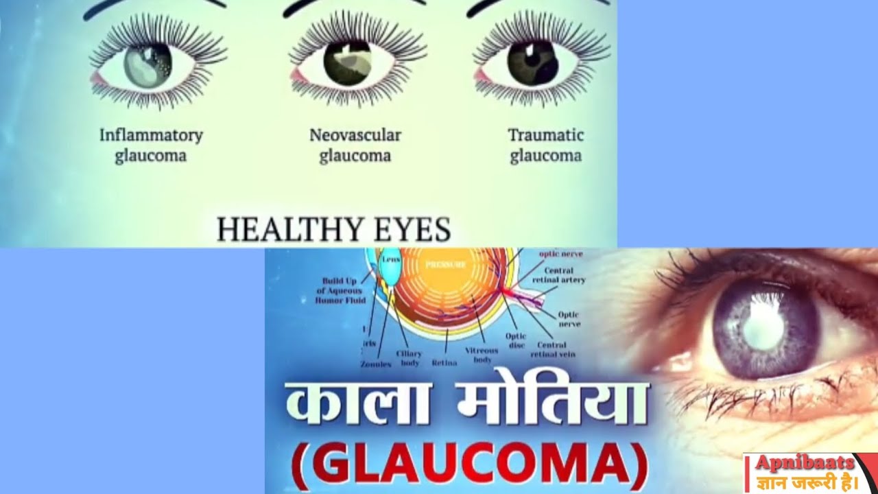 Glaucoma: Causes, Symptoms And Treatment ग्लौकोमा रोग को समझें: कारण ...