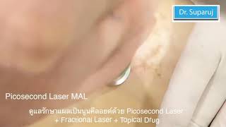 ดูแลรักษาแผลเป็นนูนคีลอยด์ด้วยเทคนิค Picosecond Laser + Fractional Laser + Topical Drug