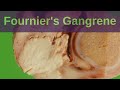 What is Fournier's Gangrene? - Pathology mini tutorial