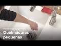 Queimaduras pequenas | Primeiros socorros