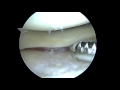 sd r knee chondroplasty and bmc procedure 11 23 15