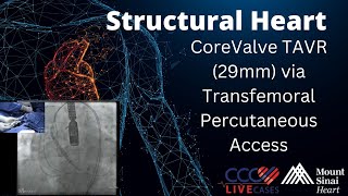 CoreValve TAVR (29mm) via Transfemoral Percutaneous Access - February 2015 Structural Live Case