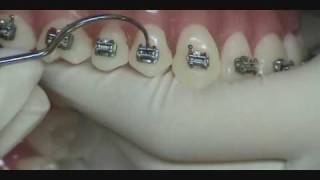 Forestadent Quick Brackets - Removing and replacing of a Quick-Clip