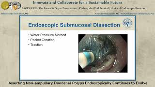 Resecting Non-ampullary Duodenal Polyps Endoscopically Continues to Evolve