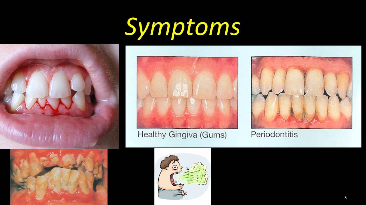 Necrotizing Ulcerative Gingivitis Vs Necrotizing Ulcerative Periodontitis