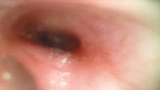 Dry ear wax removal (Left)