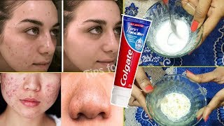 মাত্র ৫ মিনিটে টুথপেস্ট (Toothpaste) দিয়ে মুখের ব্রণ, ব্ল্যাকহেডস, রোদে পোড়া দাগ দূর করার উপায়