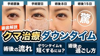 【目の下のクマ】これで怖いもの無し！気になる「ダウンタイム」の経過と過ごし方について徹底解説！【裏ハムラ・ミッドフェイスリフト】