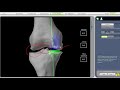 mako robotic partial knee replacement