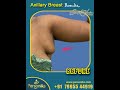 axillary breast tissue removal surgery @ personiks hyderabad dr.gurukarna vemula