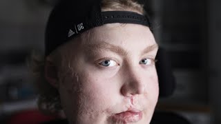 Viktor, 17, drabbades av sepsis