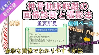 椎骨動脈解離の画像診断と撮像法