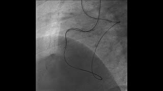 PCI for CTO part -3 retrograde