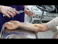 eng cc vlog recovering from finger injury│treating open compound fracture due to accident