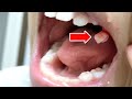 A 10-year-old girl pulls out her tooth by herself!! The moment when a tooth comes off