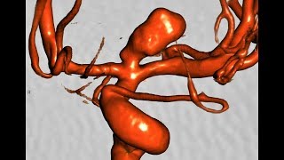 Left ICA BIFURCATION ANEURYSM COILING