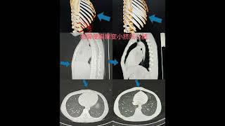 鸡胸、漏斗胸NUSS手术治疗