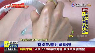 全台首例!孕婦產後眼病變視力掉到0.2