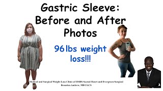 Gastric Sleeve Before and After Pictures and Results | Bariatric Weight Loss Surgery Journey Results