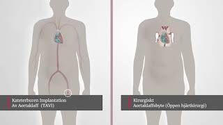 EDW101 AS Treatment Full SWEDISH HD 170912