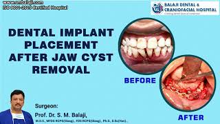 Dental Implant Placement after Jaw Cyst Removal -Dr SM Balaji, Oral and Maxillofacial Surgeon, India