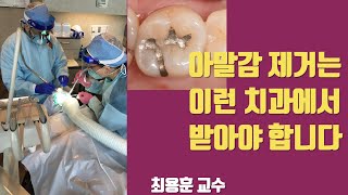 아말감 제거 아무데서나 하지 마세요 #판교최용훈치과