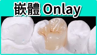 《曹博竣醫師-臨床案例系列》【嵌體】:介於牙套(crown)與樹脂填補間的另一個選擇