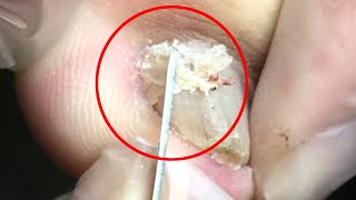 Painful swollen toe, dig out an oversized ingrown nail【DrZhang】