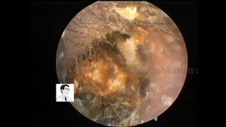 Cholesteatoma of the external auditory canal almost misdiagnosed as cerumen embolism,20230327