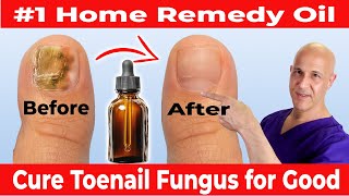 The #1 Home Remedy Oil to Cure Toenail Fungus for Good!  Dr. Mandell