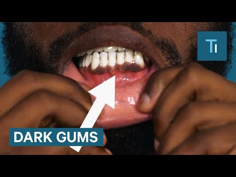 Why Some People Have Black Gums Why Some People Have Black Gums