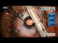 Outcomes of an IVAS injection after cataract surgery - Supplementary video [ID 247739]