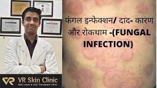 Fungal infection (फंगल इन्फेक्शन/ दाद के कारण और रोकथाम )| VR Skin Clinic, Bikaner |Dr Vineet Kumar