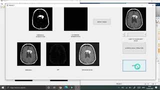 how to find out brain tumor in matlab || image processing || machine learning #matlab