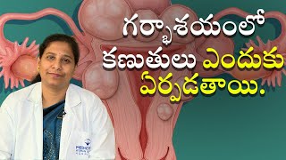 Uterine Fibroids Symptoms And Causes | గర్భాశయంలో కణుతులు ఎందుకు ఏర్పడతాయి | Samayam Telugu