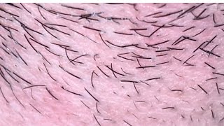 ASMR Super Relaxing beard Comfortably scalp | Ingrown 10 ingrown