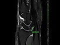 Radioscaphocapitate ligament injury and TFCC tear - Wrist MRI scan | First Look MRI