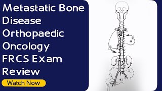 Metastatic Bone Disease | Orthopaedic Oncology - FRCS Exam Review | Orthopaedic Academy