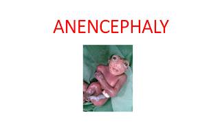 ANENCEPHALY