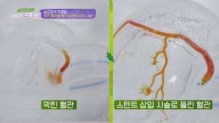 막힌 혈관을 뻥↗ 심근경색의 치료 방법 = [스텐드 삽입 시술] 맛있는 이야기 미라클 푸드(Miracle Food) 108회 | JTBC 210501 방송