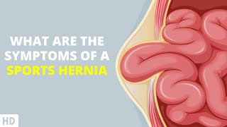 When Athletics Take a Toll: Recognizing Symptoms of a Sports Hernia