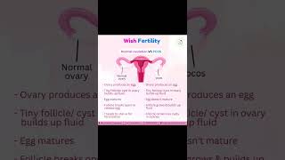 Spot the Difference: PCOS vs. Normal Ovary. #PCOSAwareness #OvarianHealth