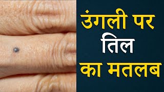 उंगली पर तिल का मतलब | Mole on finger means