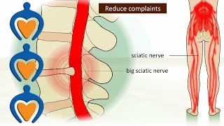 Lower back pain (a.o. sciatica, herniated disk) - It's causes, symptoms and treatment.
