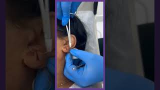 Easy Earlobe Surgery by Dr. Sanjay Sakhamuri | Sasha Clinics | Hyderabad