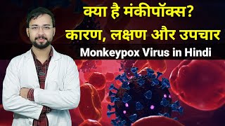 क्या है मंकीपॉक्स? कारण, लक्षण और उपचार | Monkeypox Virus in Hindi | Monkeypox symptoms & Prevention